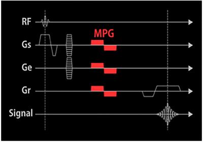 Peliminary exploration on the differential diagnosis between meningioma and schwannoma using contrast-enhanced T1WI flow-sensitive black-blood sequence